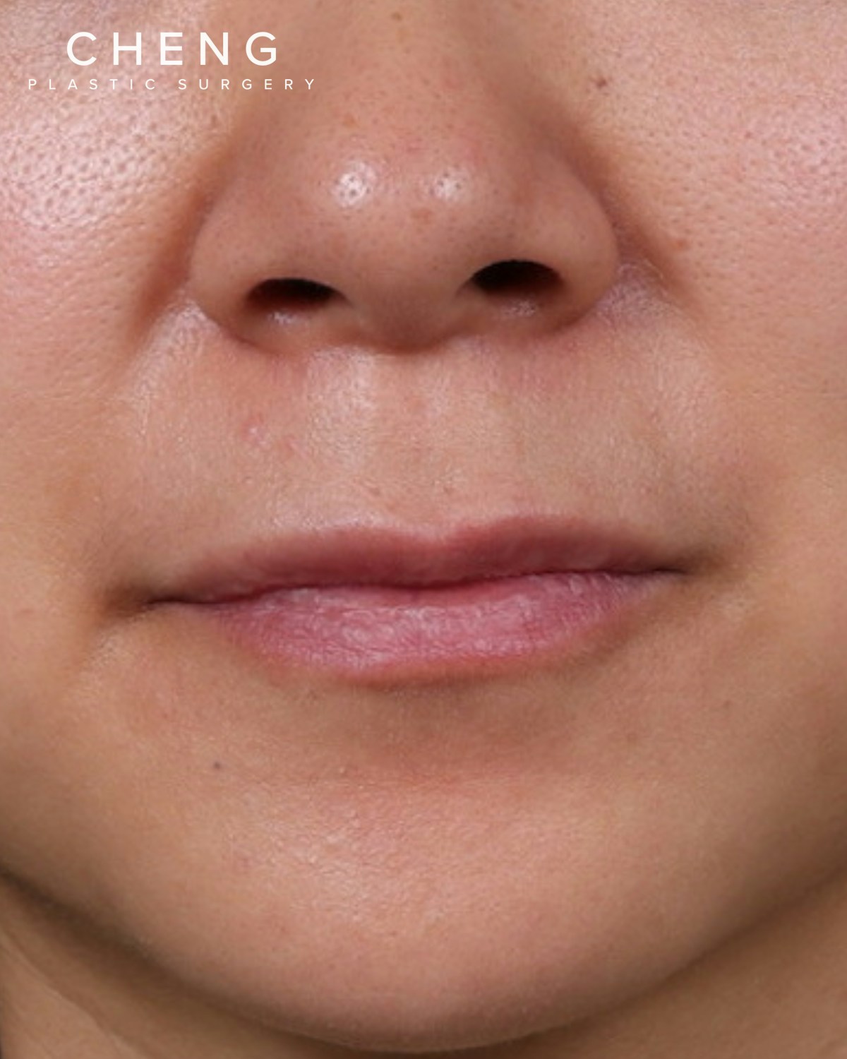 Dermal Fillers Before & After Gallery - Patient 206577 - Image 1