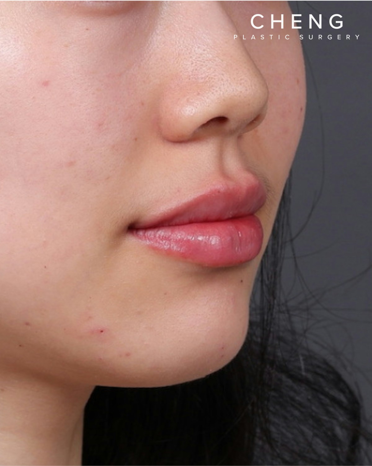 Dermal Fillers Before & After Gallery - Patient 377909 - Image 4