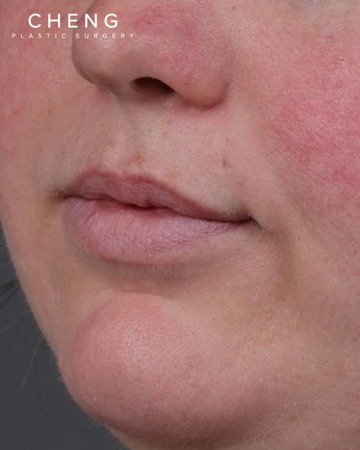 Dermal Fillers Before & After Gallery - Patient 296170 - Image 3