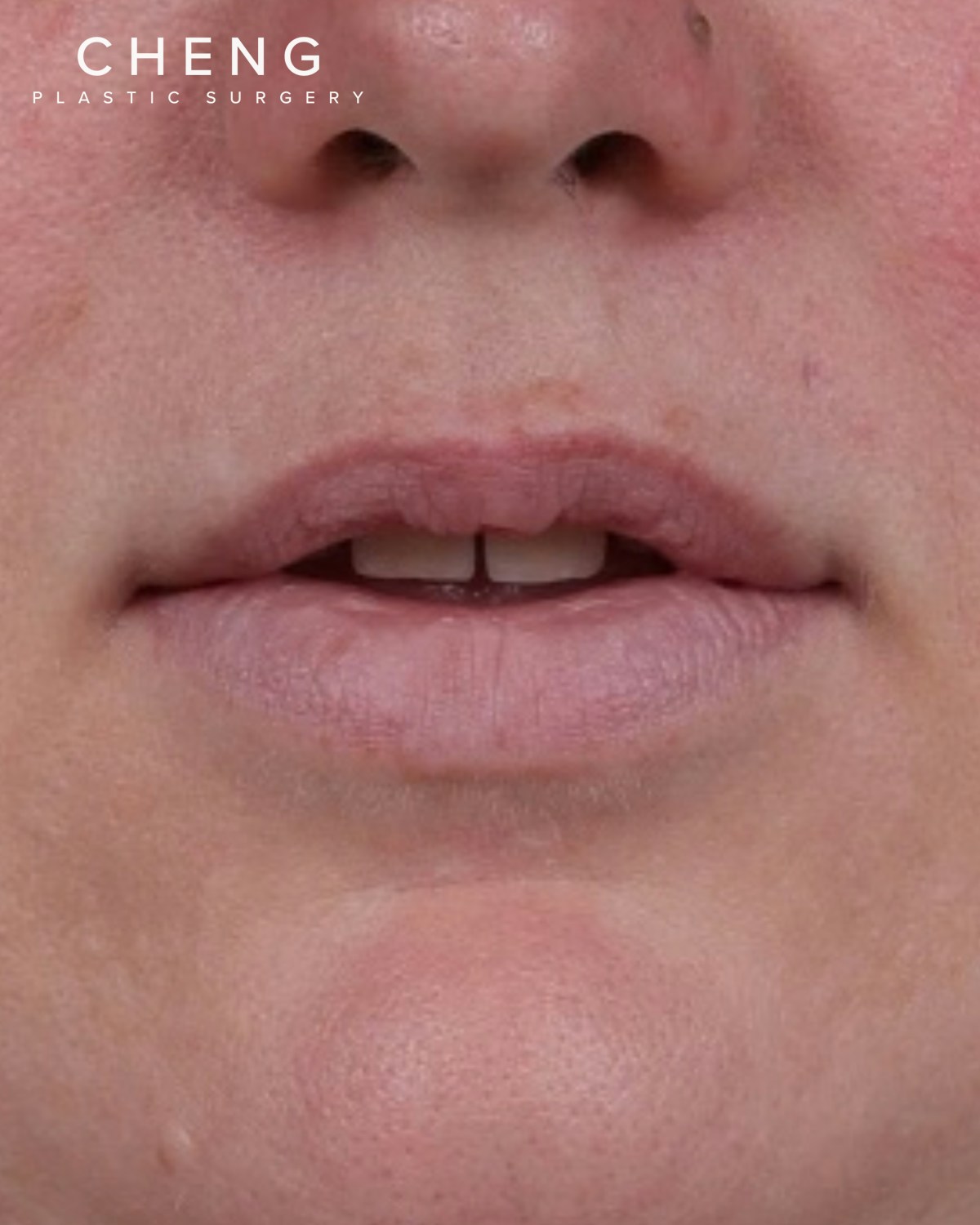 Dermal Fillers Before & After Gallery - Patient 296170 - Image 1
