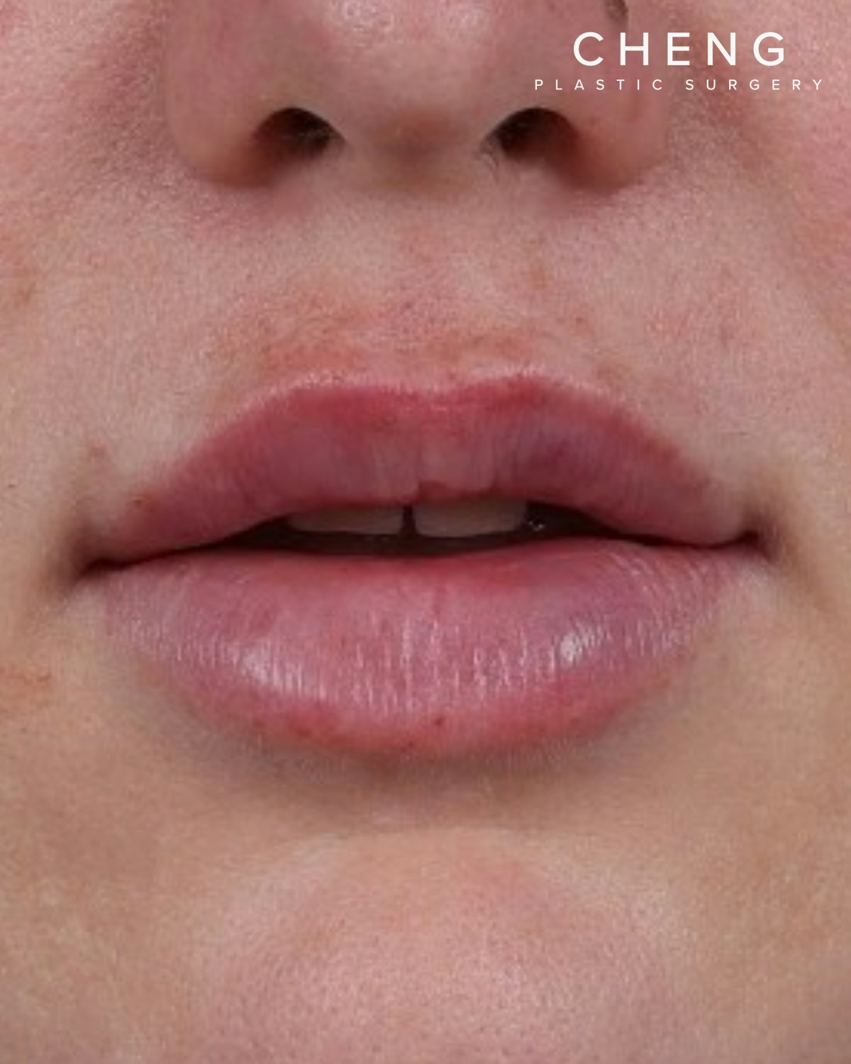 Dermal Fillers Before & After Gallery - Patient 296170 - Image 2