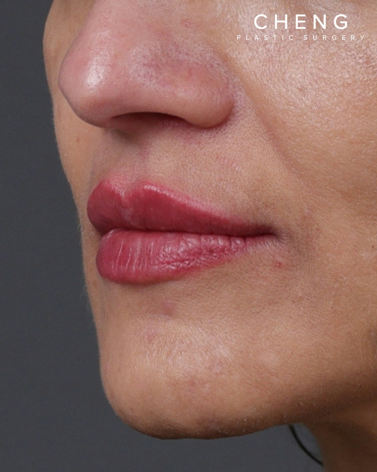 Dermal Fillers Before & After Gallery - Patient 119274 - Image 4