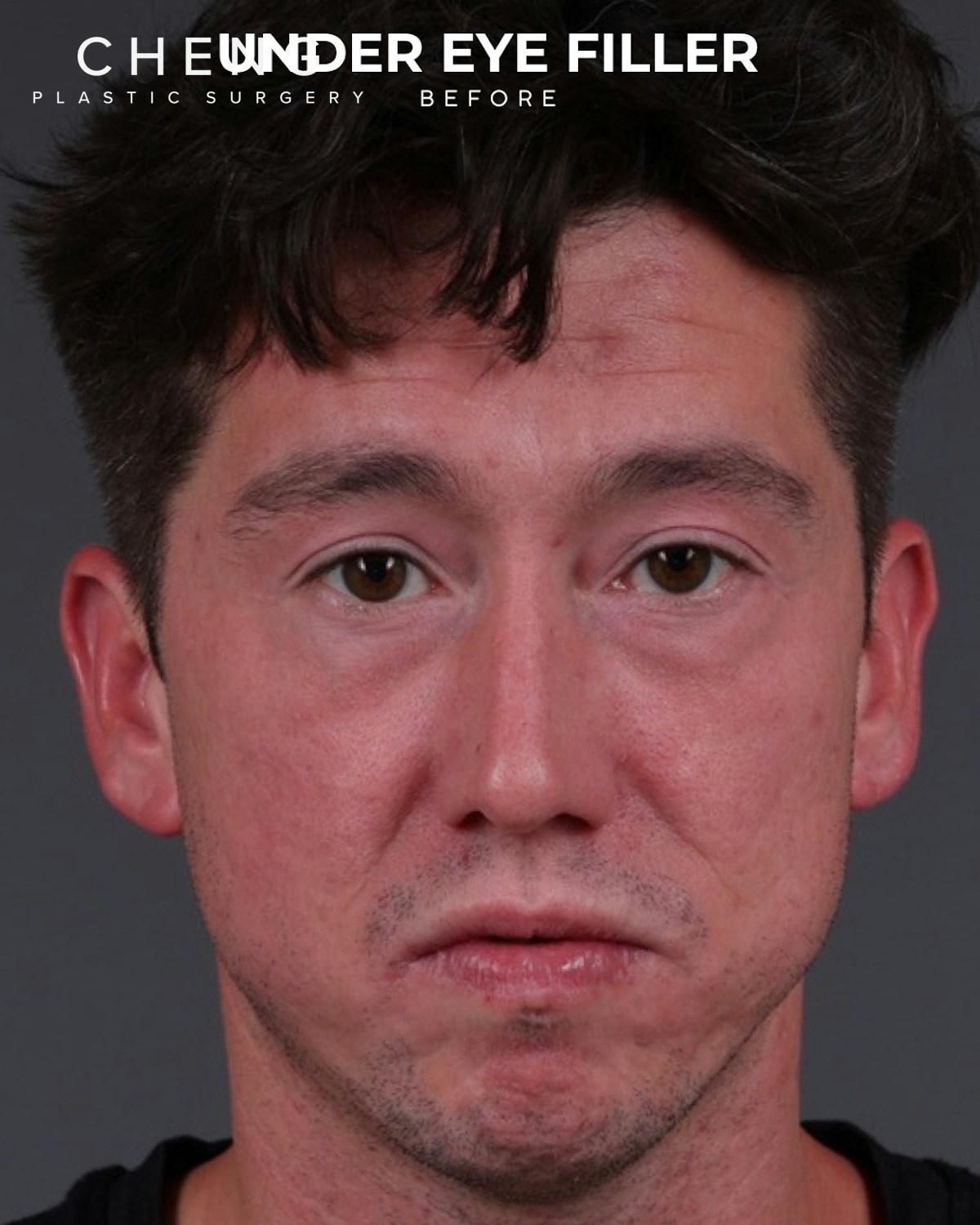 Dermal Fillers Before & After Gallery - Patient 934032 - Image 1