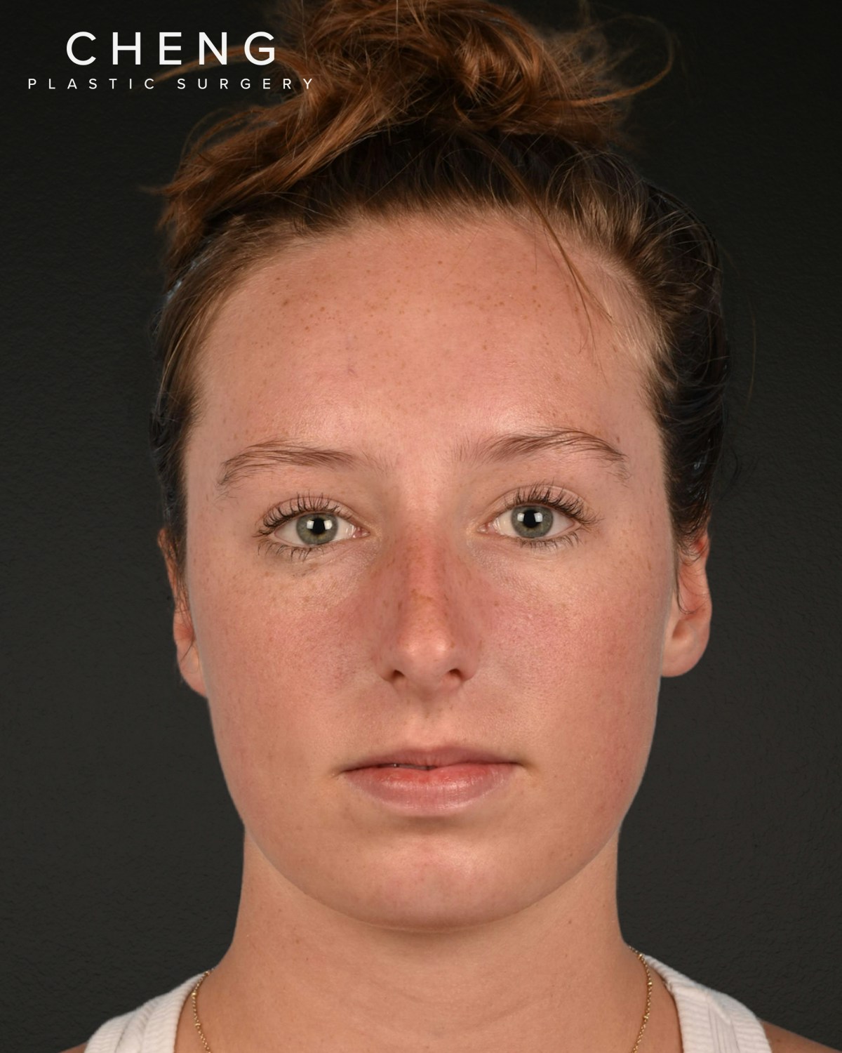 Rhinoplasty Before & After Gallery - Patient 356462 - Image 3