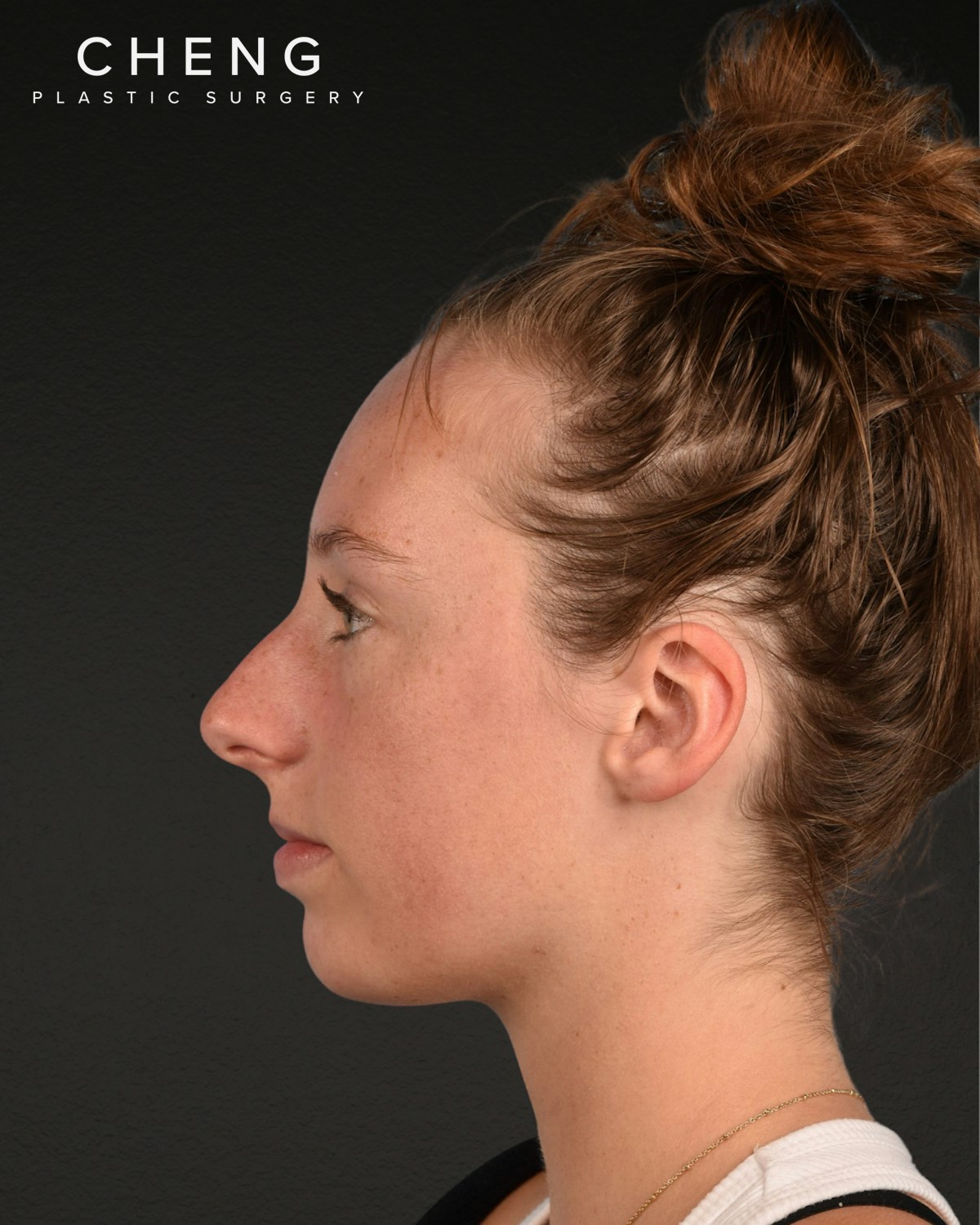 Rhinoplasty Before & After Gallery - Patient 356462 - Image 9