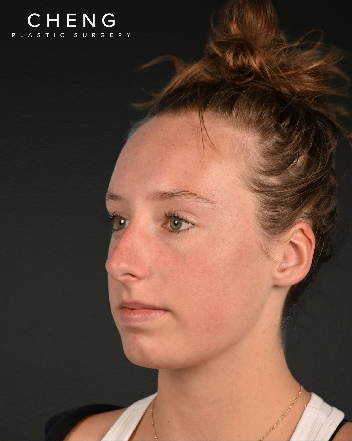 Rhinoplasty Before & After Gallery - Patient 356462 - Image 5