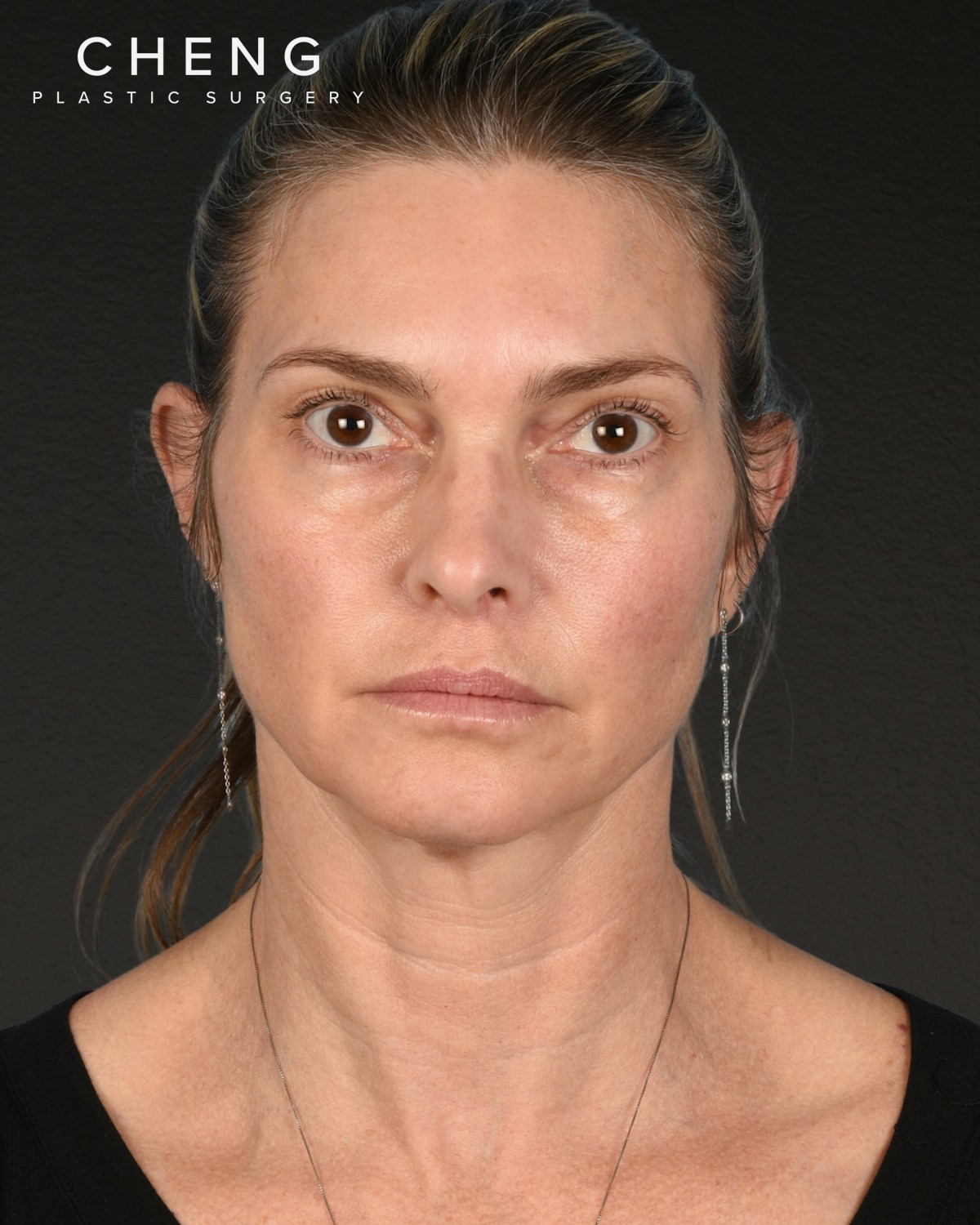 Facelift Before & After Gallery - Patient 127422 - Image 1
