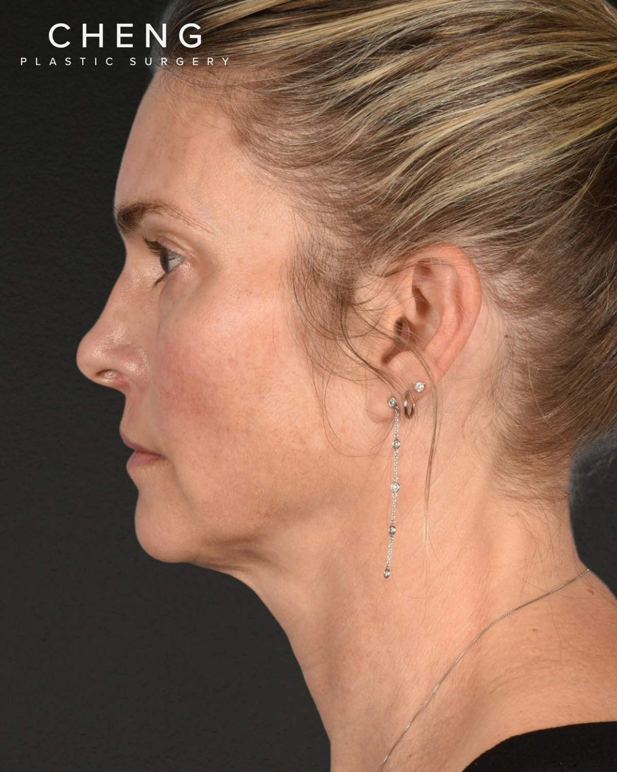 Facelift Before & After Gallery - Patient 127422 - Image 5