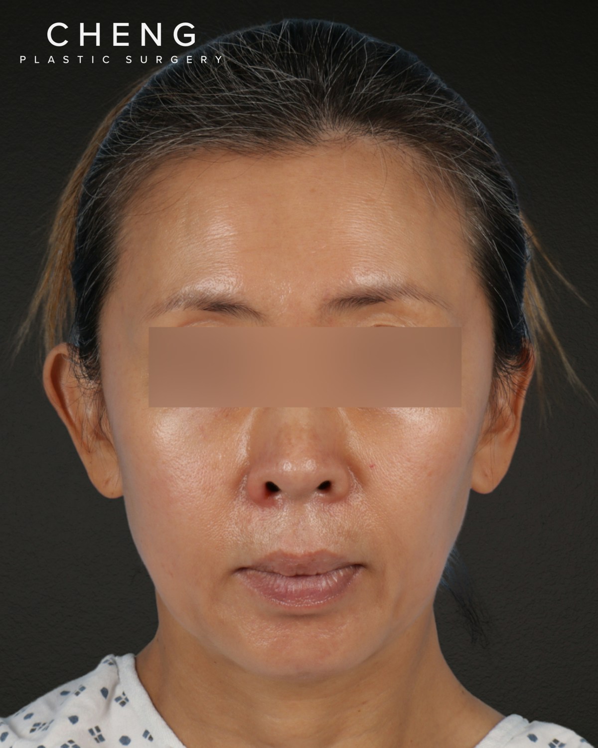 Facelift Before & After Gallery - Patient 178633 - Image 5