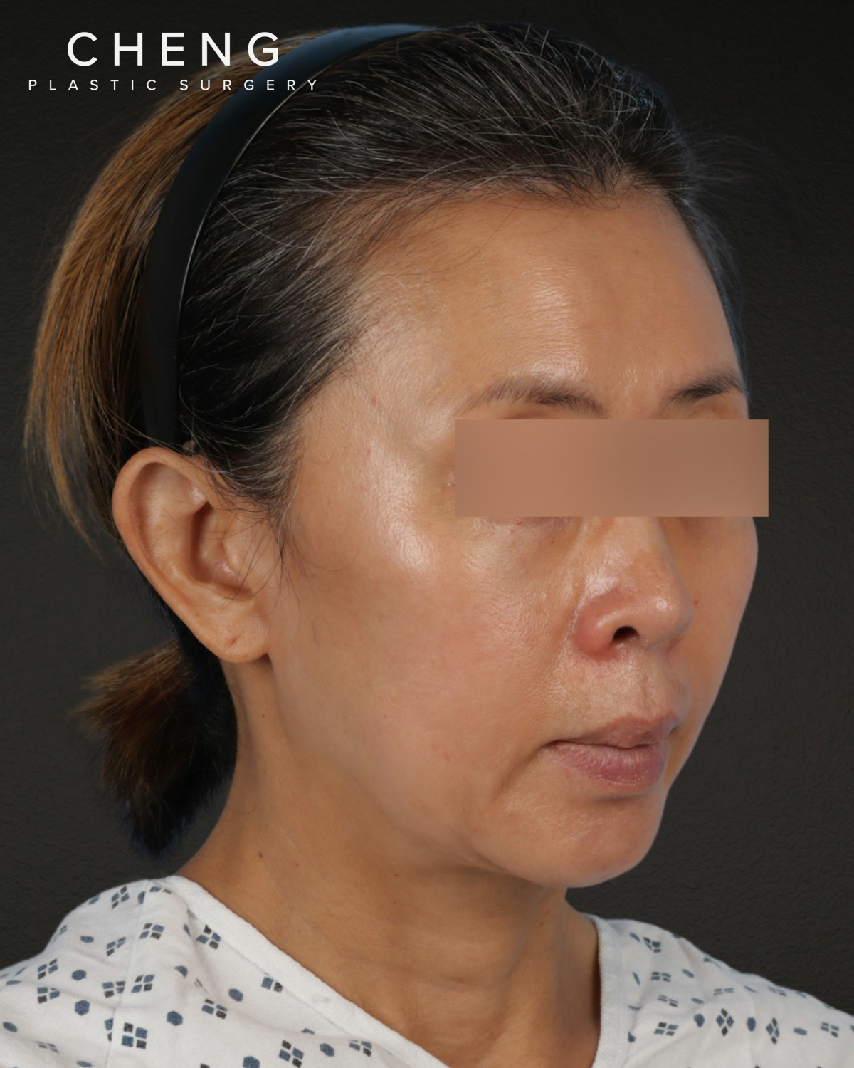 Facelift Before & After Gallery - Patient 178633 - Image 3