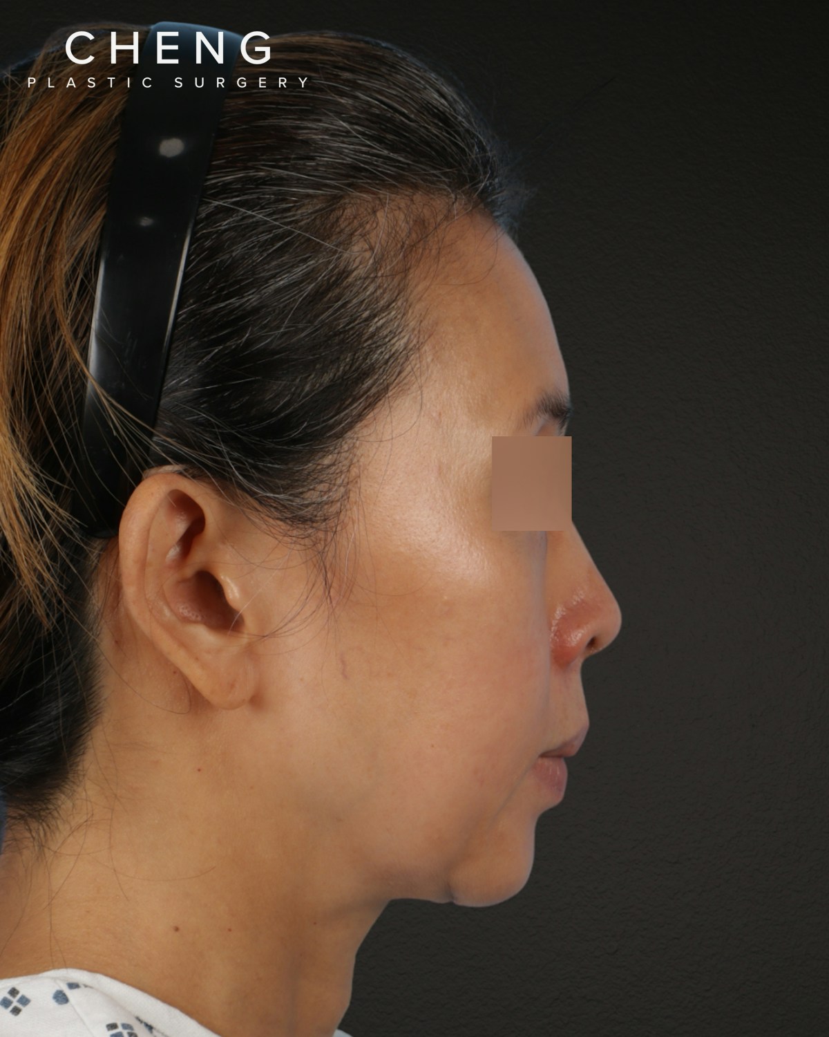 Facelift Before & After Gallery - Patient 178633 - Image 1