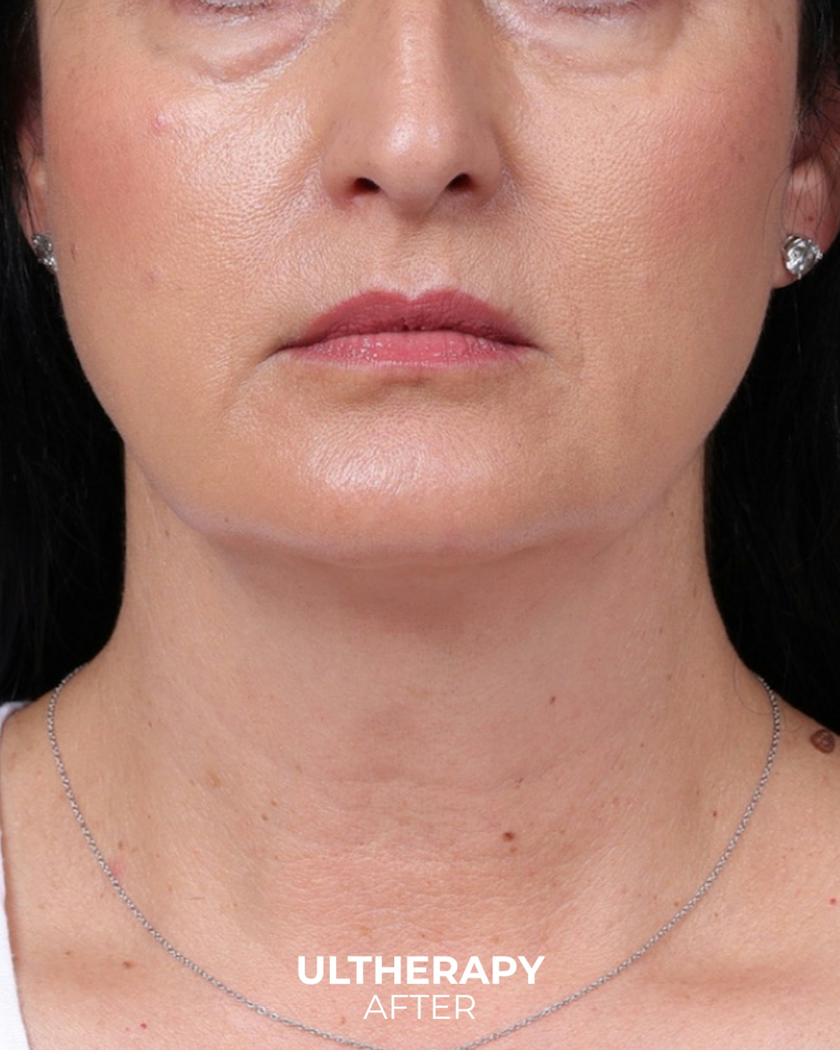 Ultherapy Before & After Gallery - Patient 134958 - Image 4