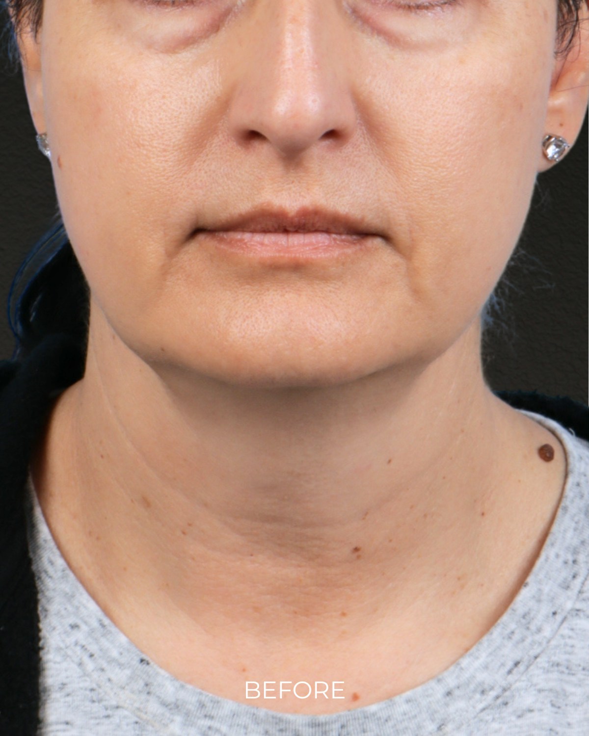 Ultherapy Before & After Gallery - Patient 134958 - Image 3
