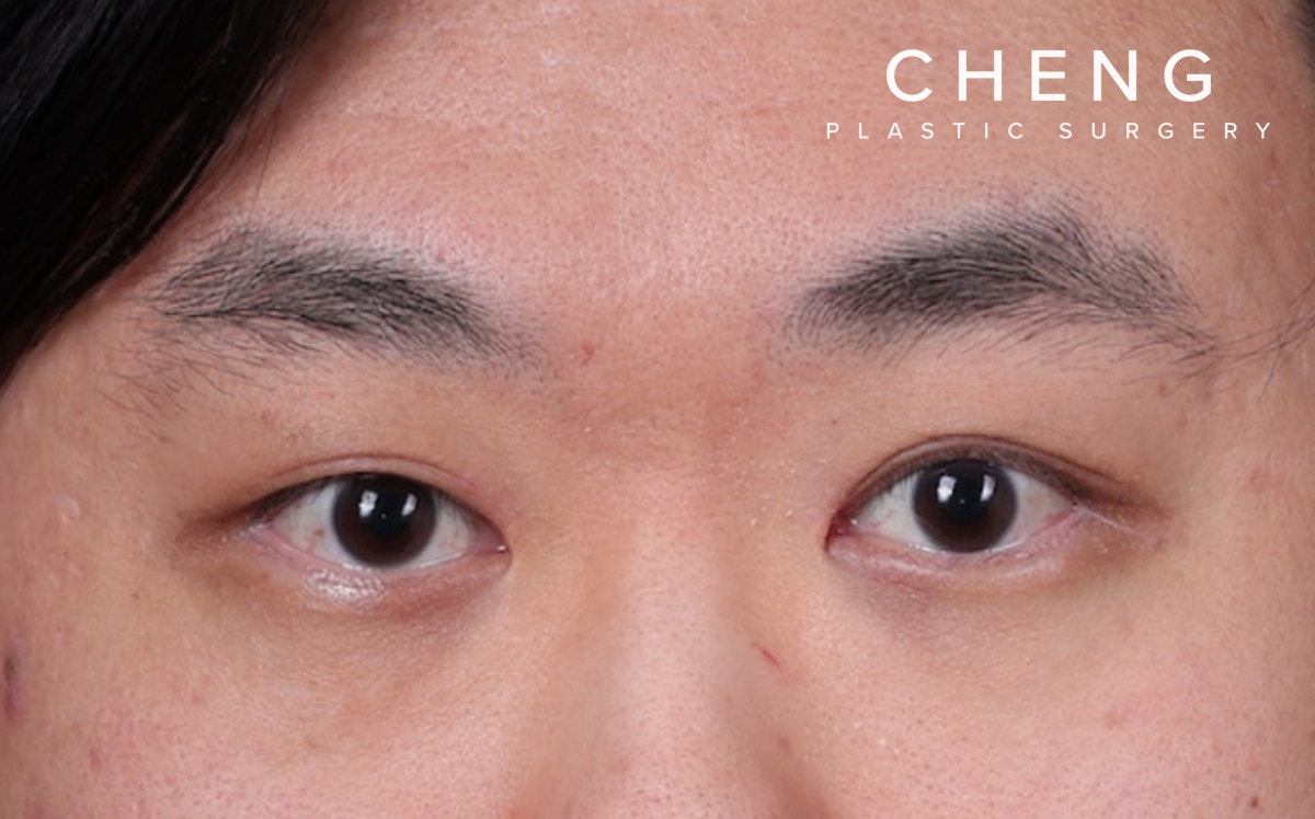 Blepharoplasty Before & After Gallery - Patient 402892 - Image 2