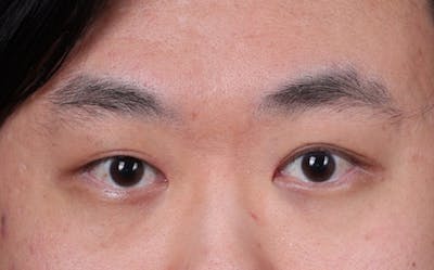 Blepharoplasty Before & After Gallery - Patient 402892 - Image 2