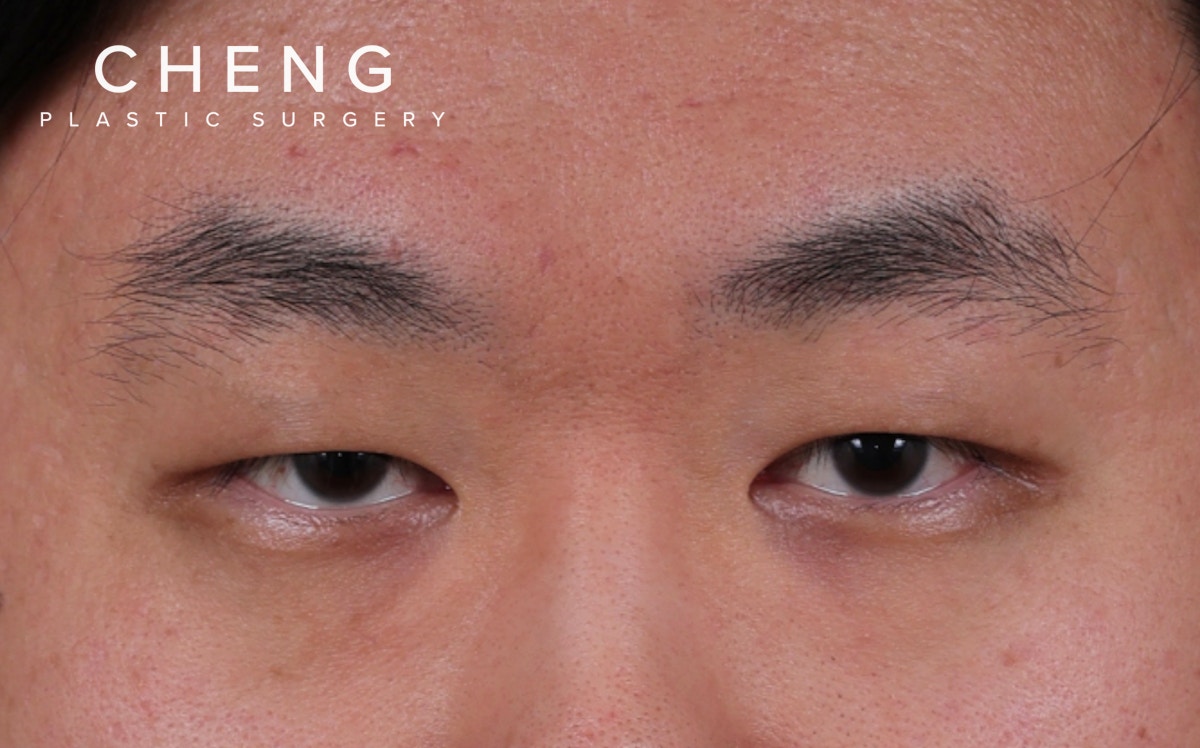 Blepharoplasty Before & After Gallery - Patient 402892 - Image 1