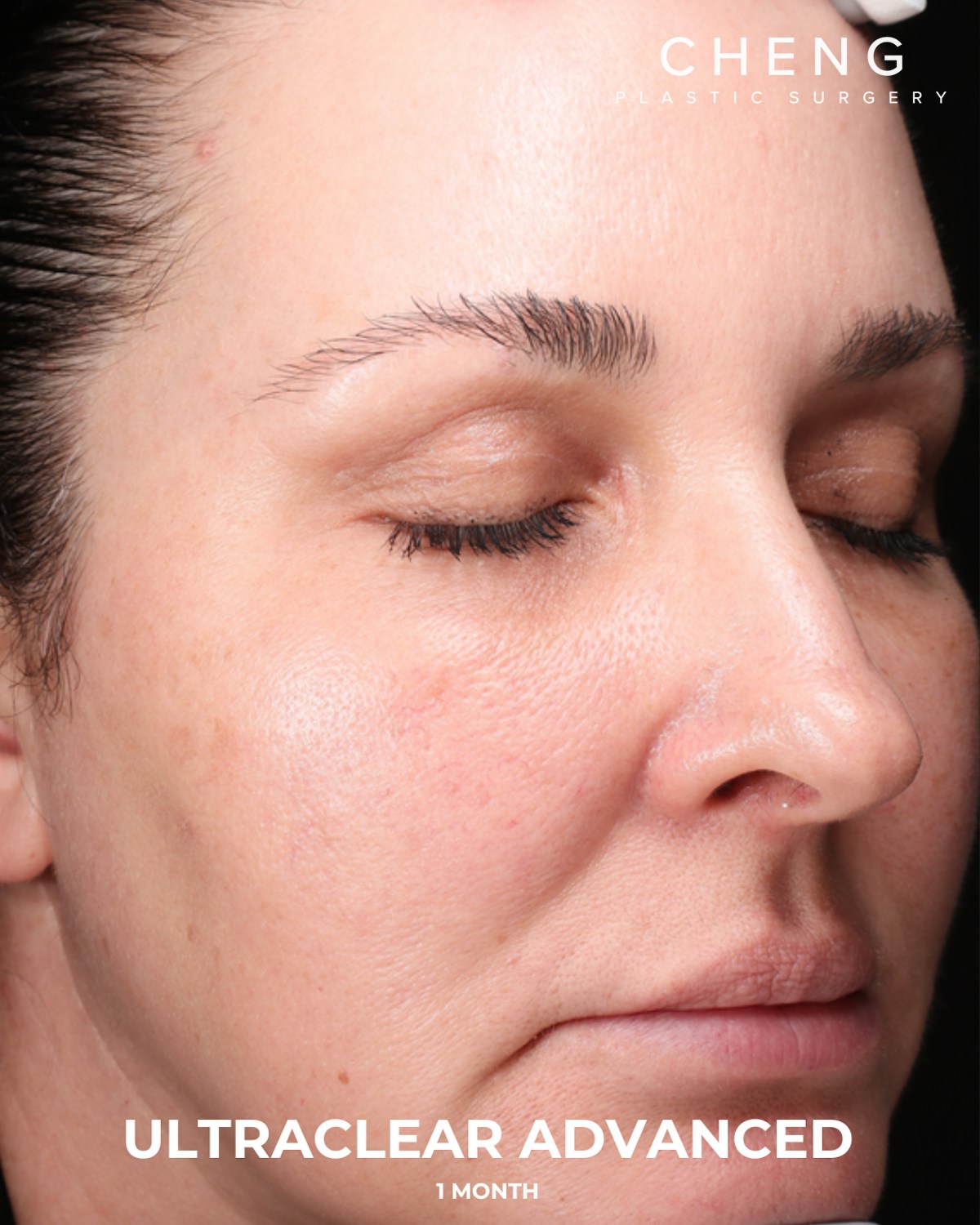 UltraClear Before & After Gallery - Patient 223793 - Image 4