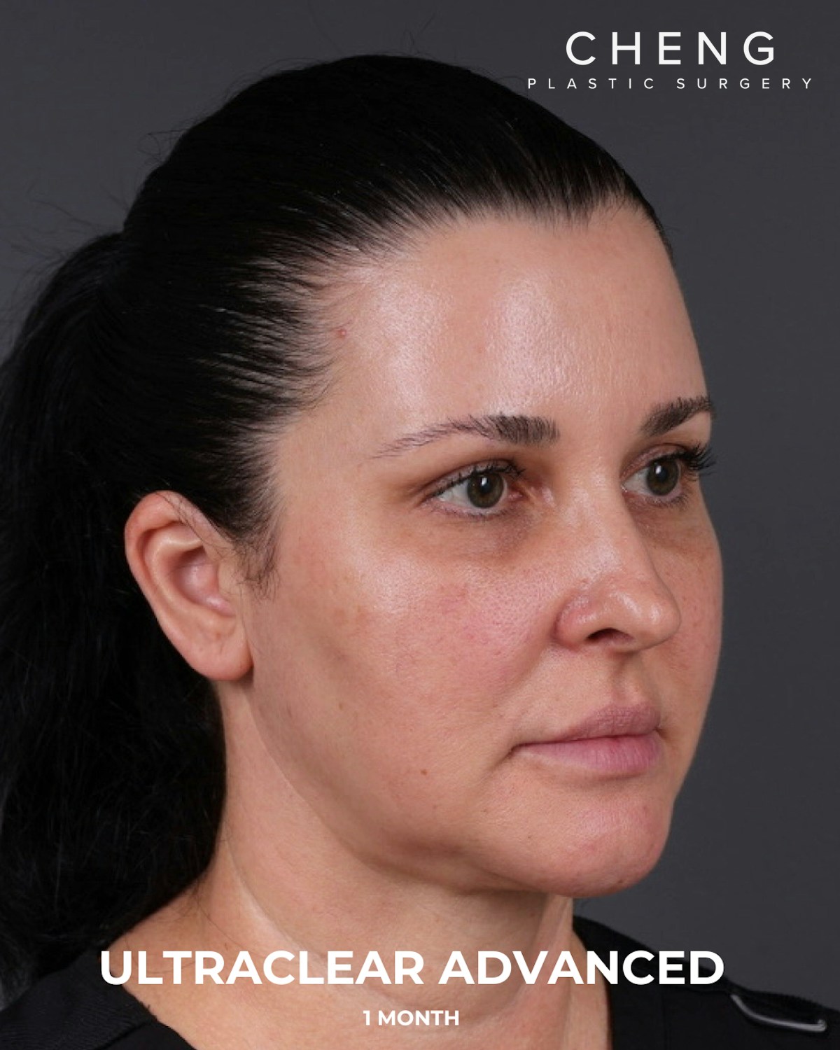 UltraClear Before & After Gallery - Patient 223793 - Image 10