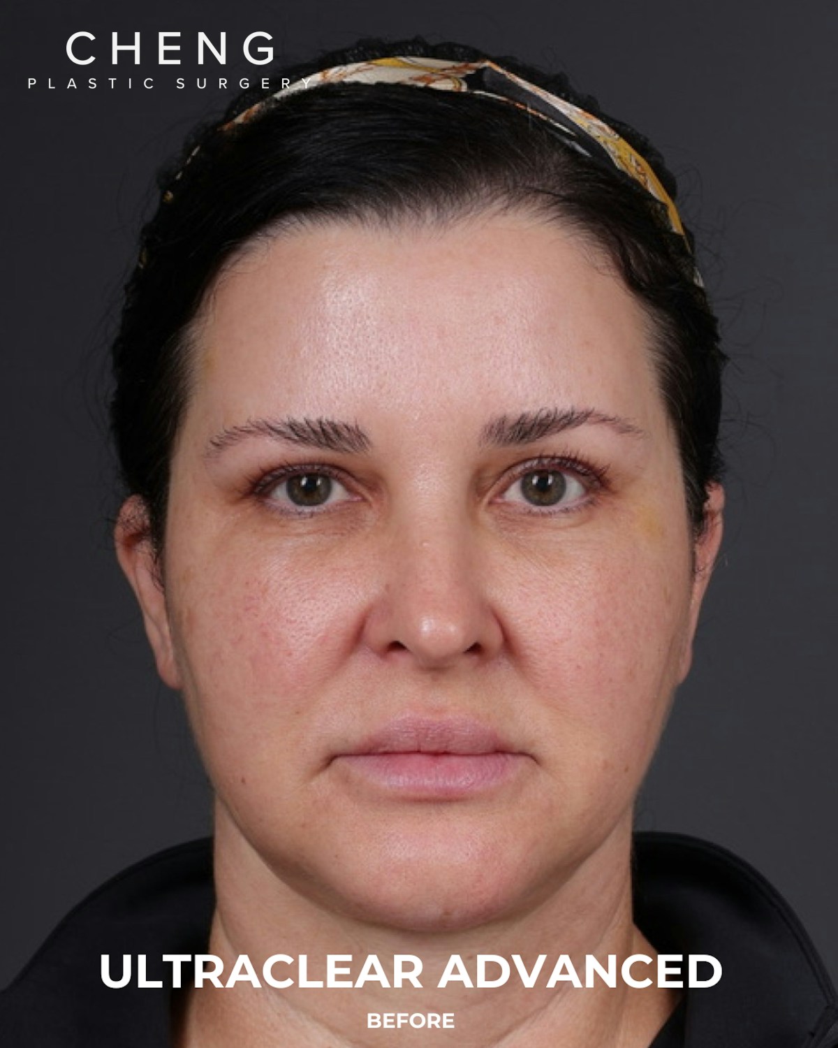 UltraClear Before & After Gallery - Patient 223793 - Image 7