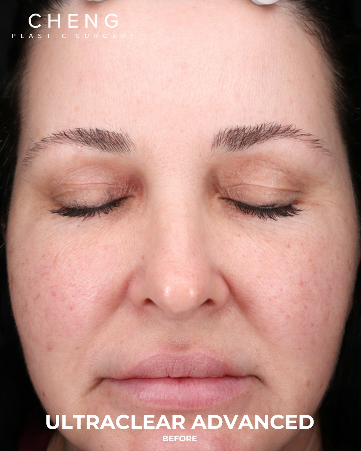 UltraClear Before & After Gallery - Patient 223793 - Image 1