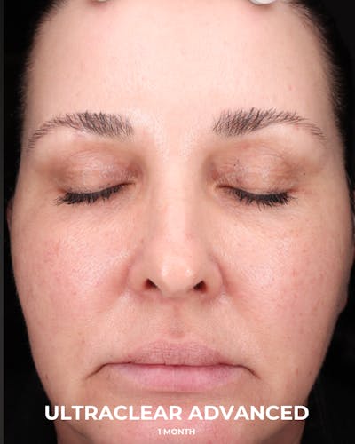UltraClear Before & After Gallery - Patient 223793 - Image 2
