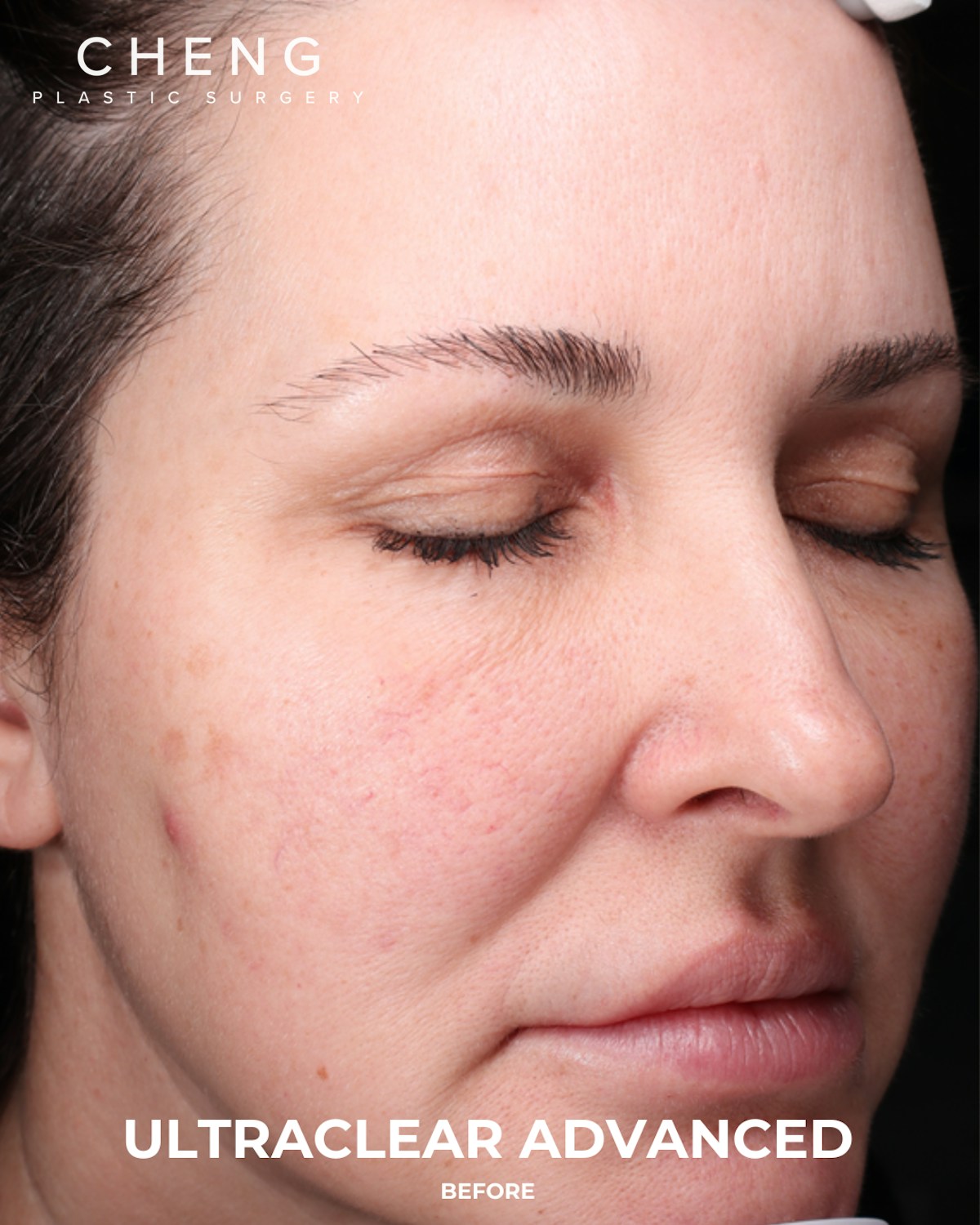 UltraClear Before & After Gallery - Patient 223793 - Image 3