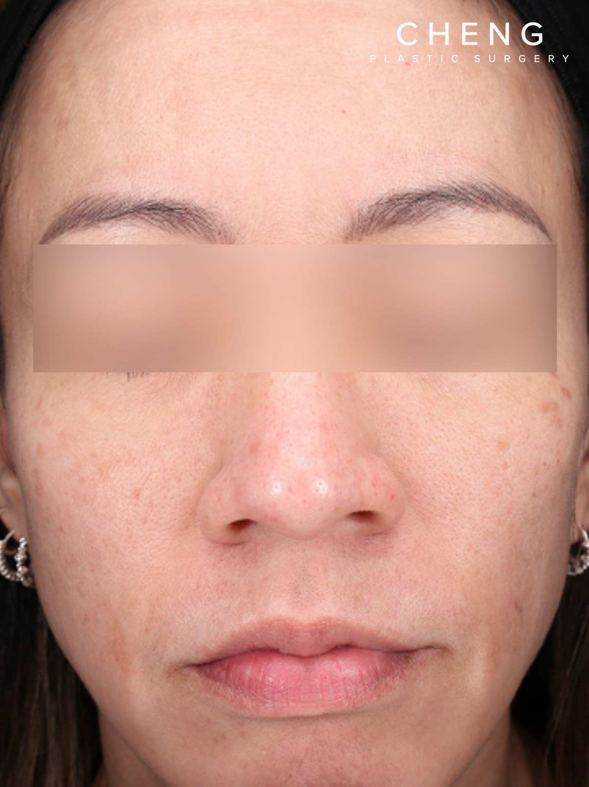 VI Peel Before & After Gallery - Patient 228367 - Image 2