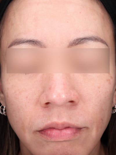 VI Peel Before & After Gallery - Patient 228367 - Image 2