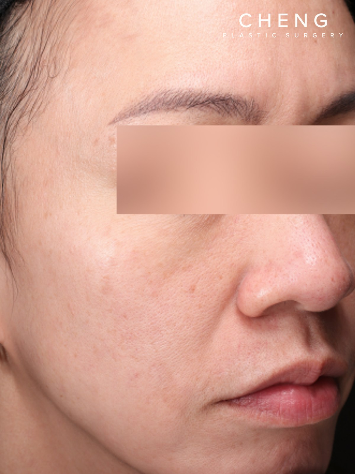 VI Peel Before & After Gallery - Patient 228367 - Image 4