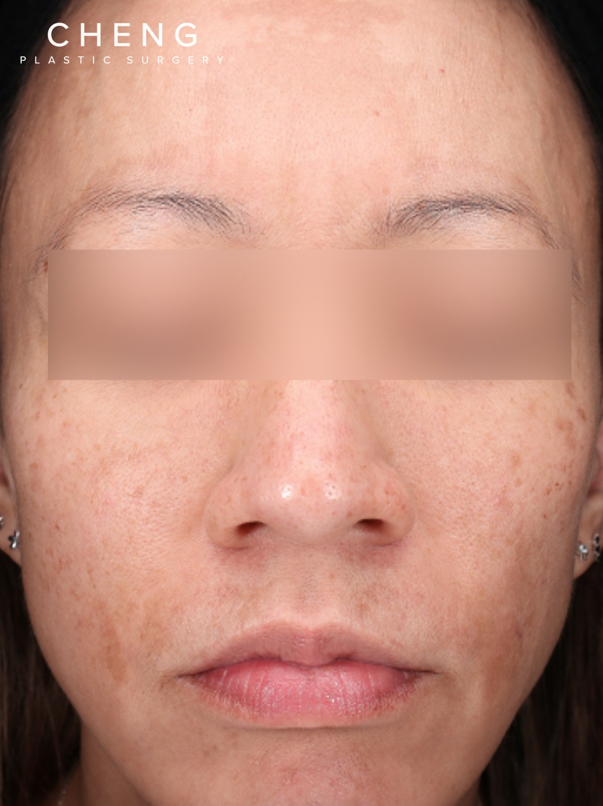 VI Peel Before & After Gallery - Patient 228367 - Image 1