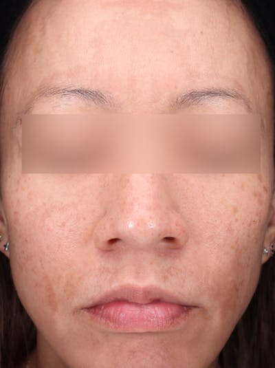 VI Peel Before & After Gallery - Patient 228367 - Image 1