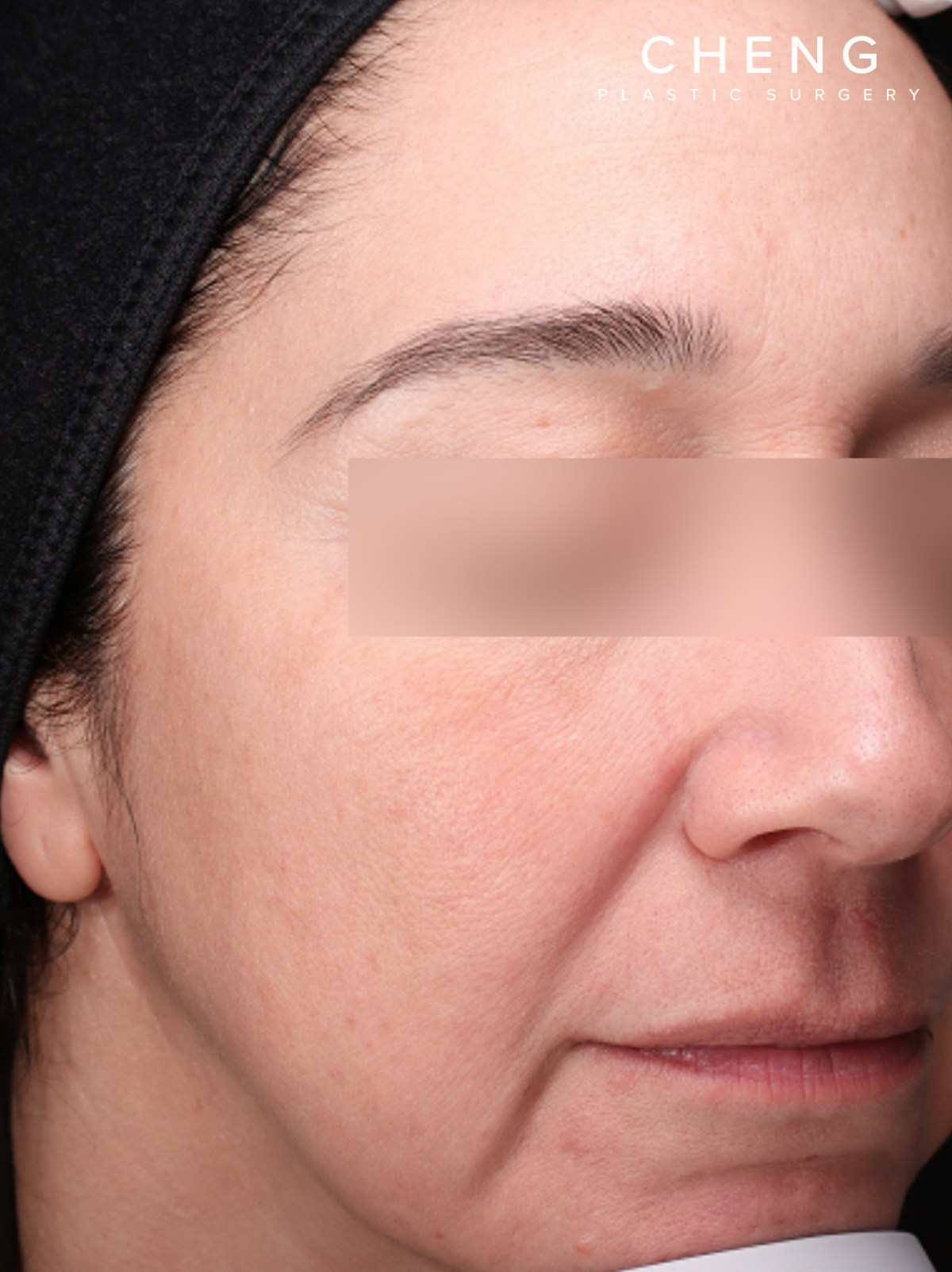 Pigment Laser Before & After Gallery - Patient 372700 - Image 4