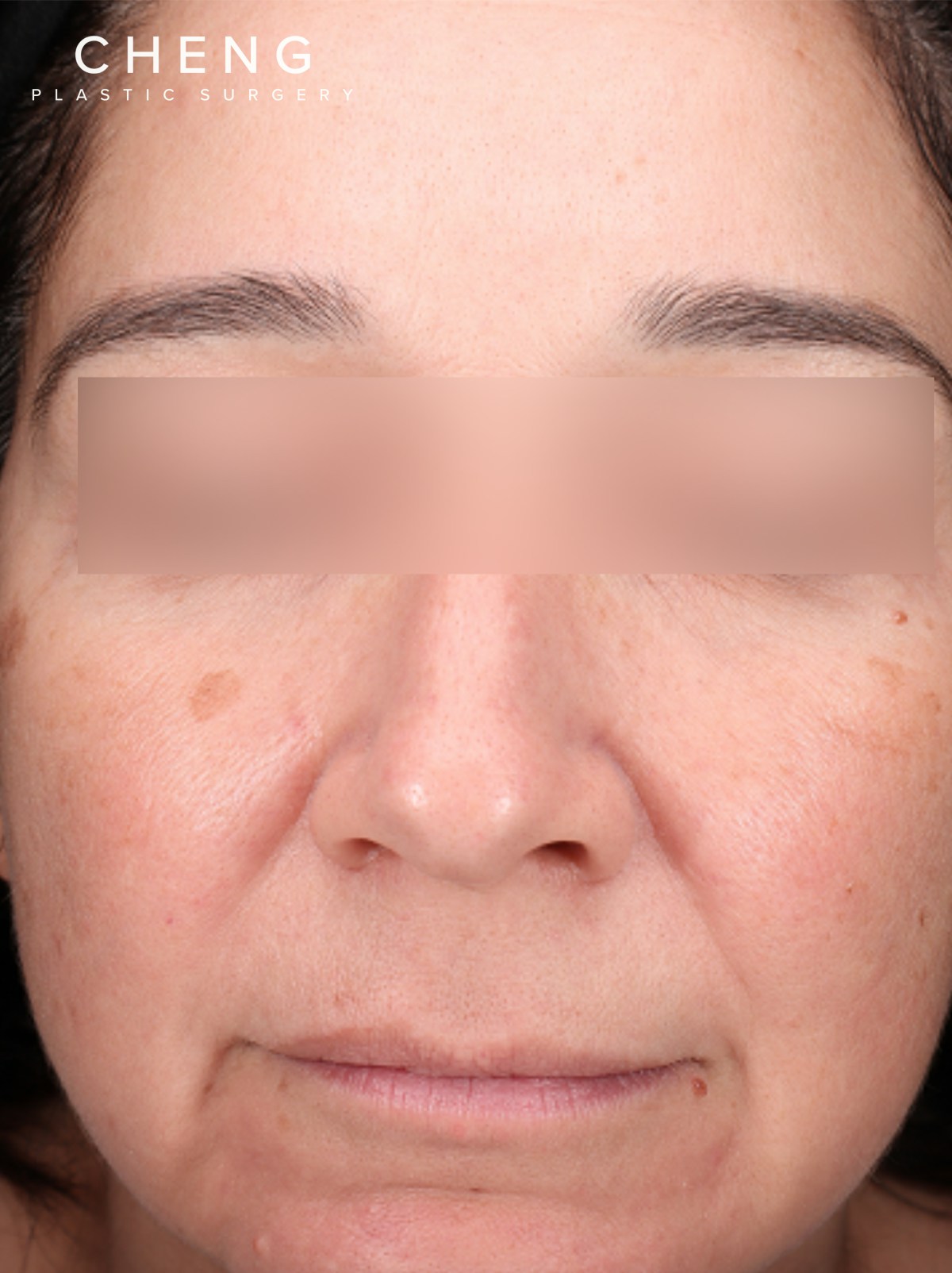 Pigment Laser Before & After Gallery - Patient 372700 - Image 1