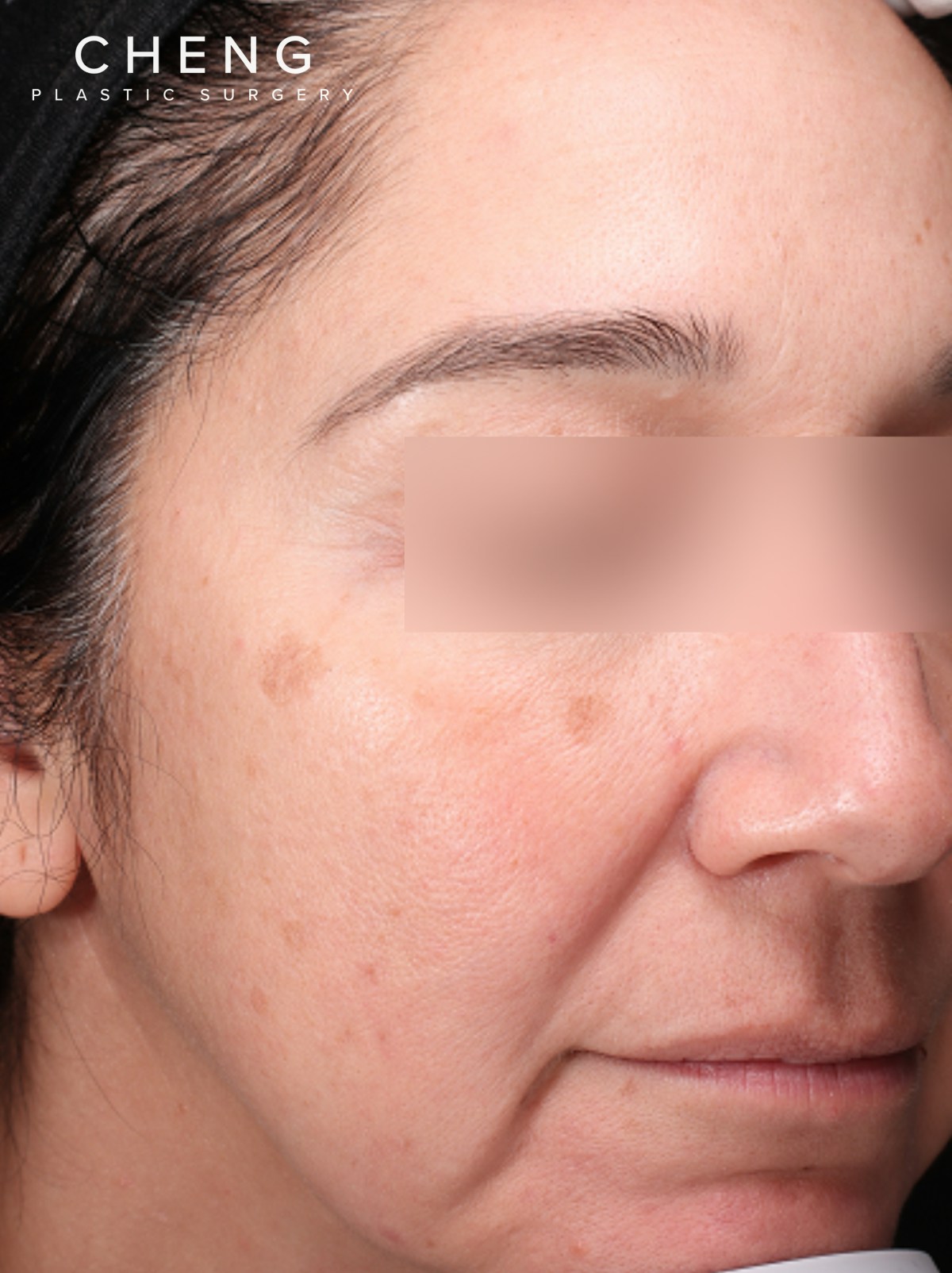 Pigment Laser Before & After Gallery - Patient 372700 - Image 3