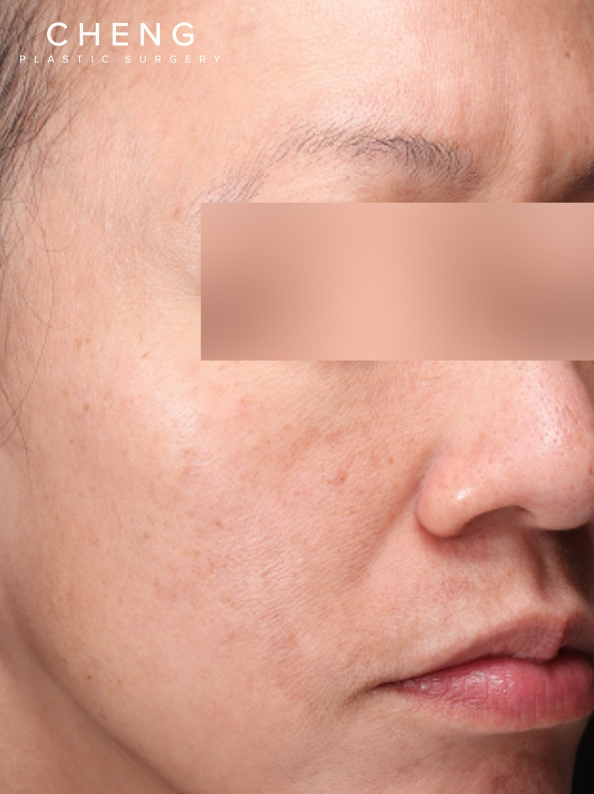 VI Peel Before & After Gallery - Patient 228367 - Image 3