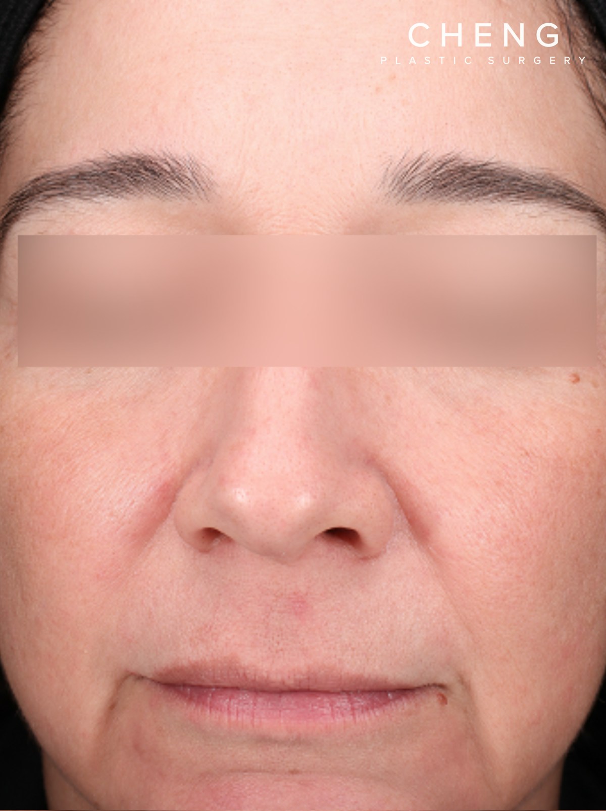 Pigment Laser Before & After Gallery - Patient 372700 - Image 2