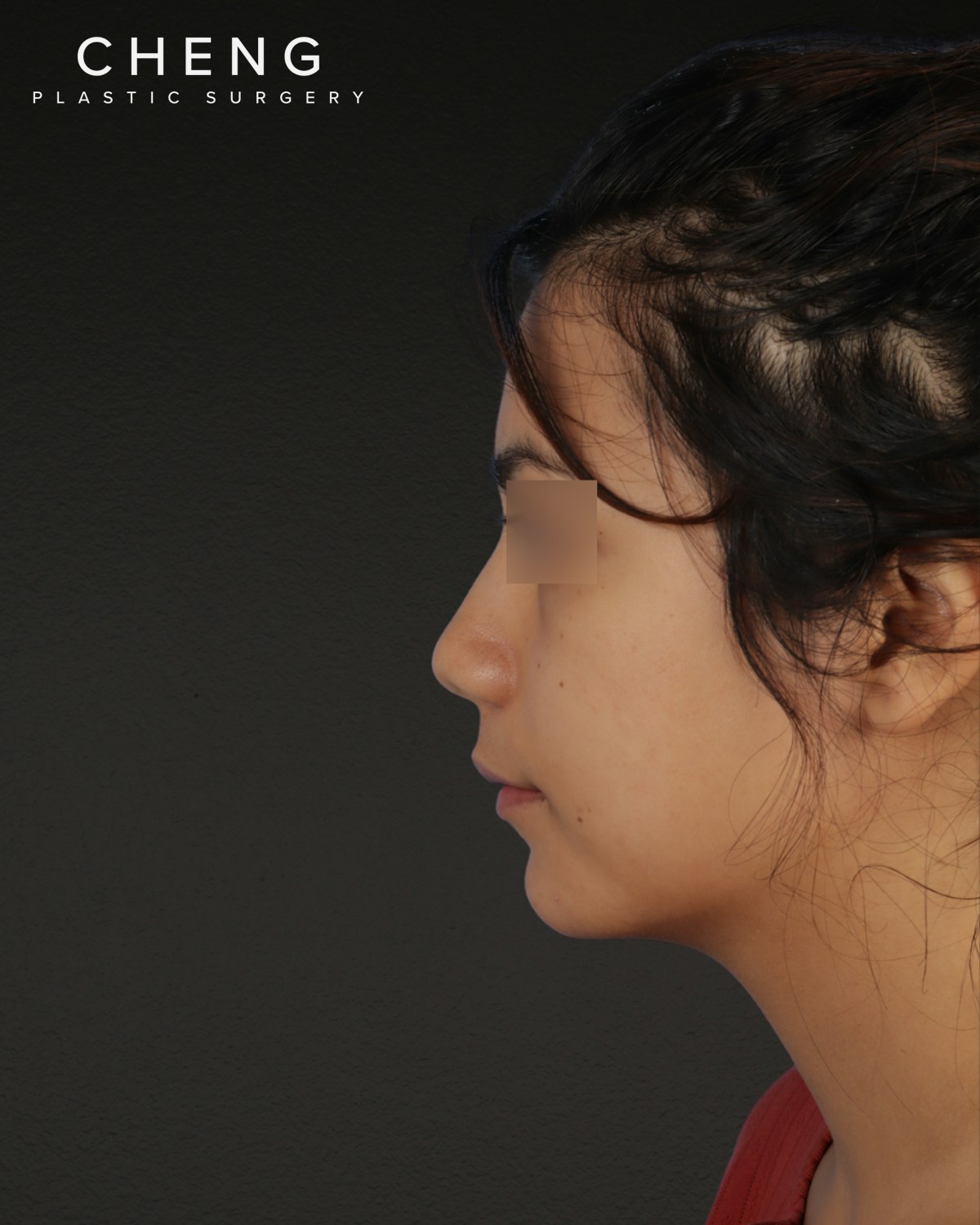 Rhinoplasty Before & After Gallery - Patient 342648 - Image 3