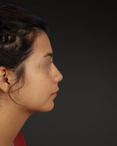 Rhinoplasty Before & After Gallery - Patient 342648 - Image 1