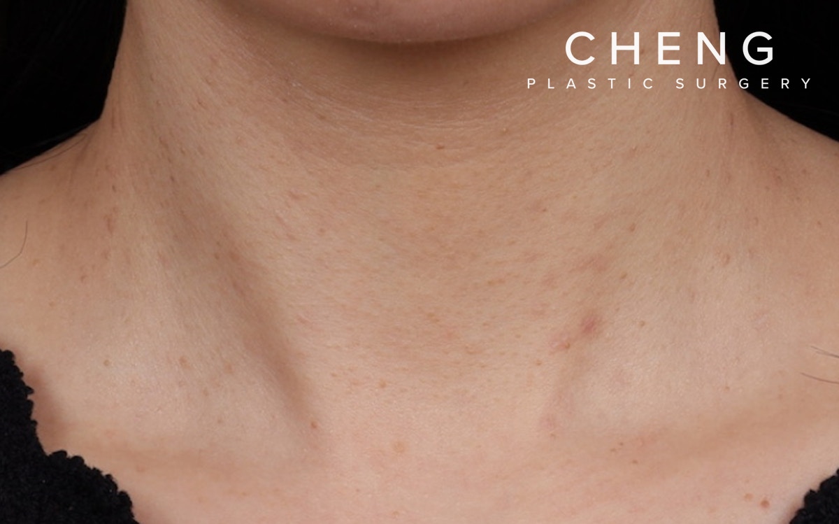 BBL Laser Before & After Gallery - Patient 949626 - Image 2