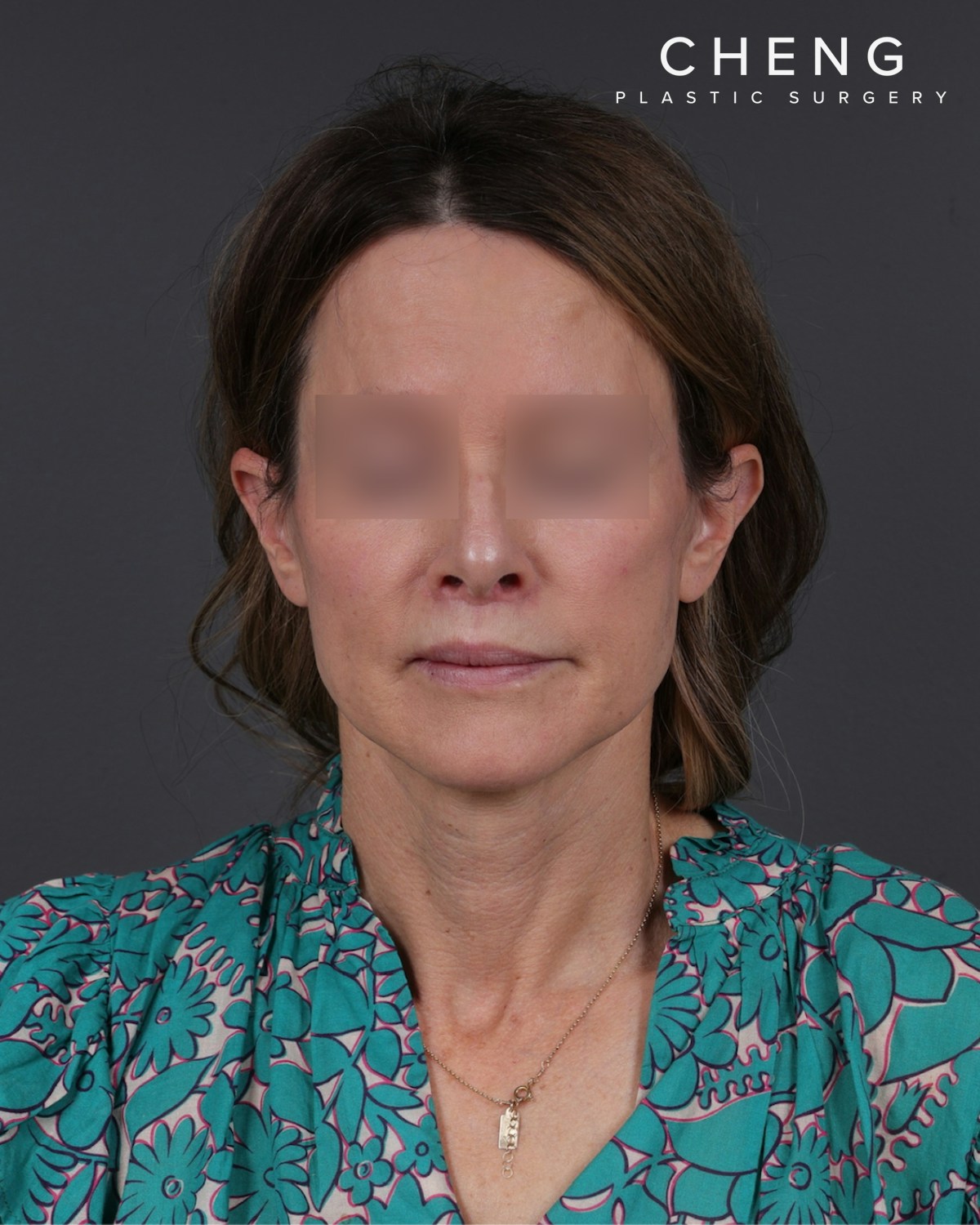 Facelift Before & After Gallery - Patient 263076 - Image 2