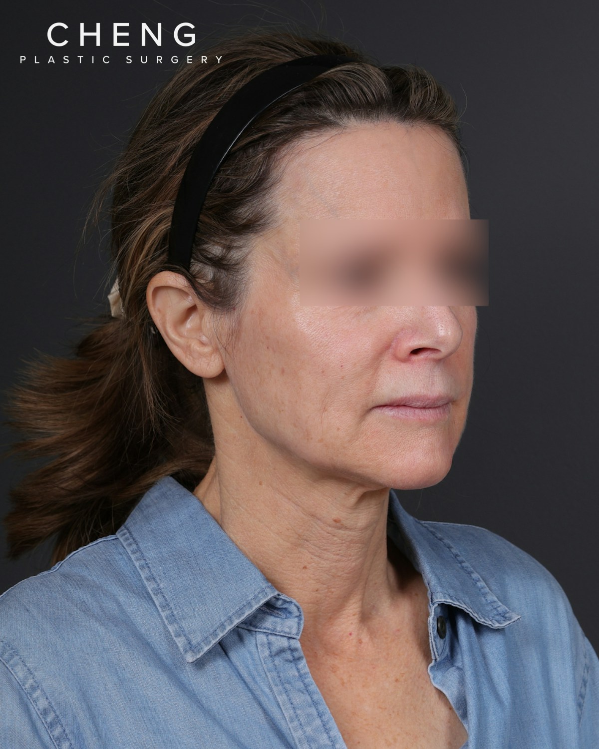 Facelift Before & After Gallery - Patient 263076 - Image 3