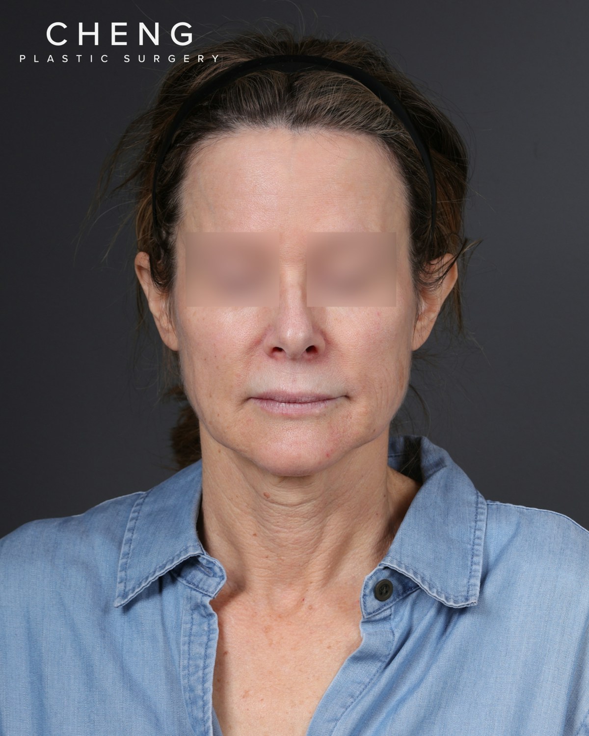 Facelift Before & After Gallery - Patient 263076 - Image 1