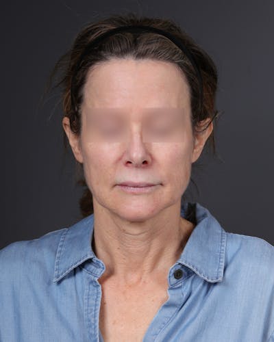 Neck Lift Before & After Gallery - Patient 260602 - Image 1