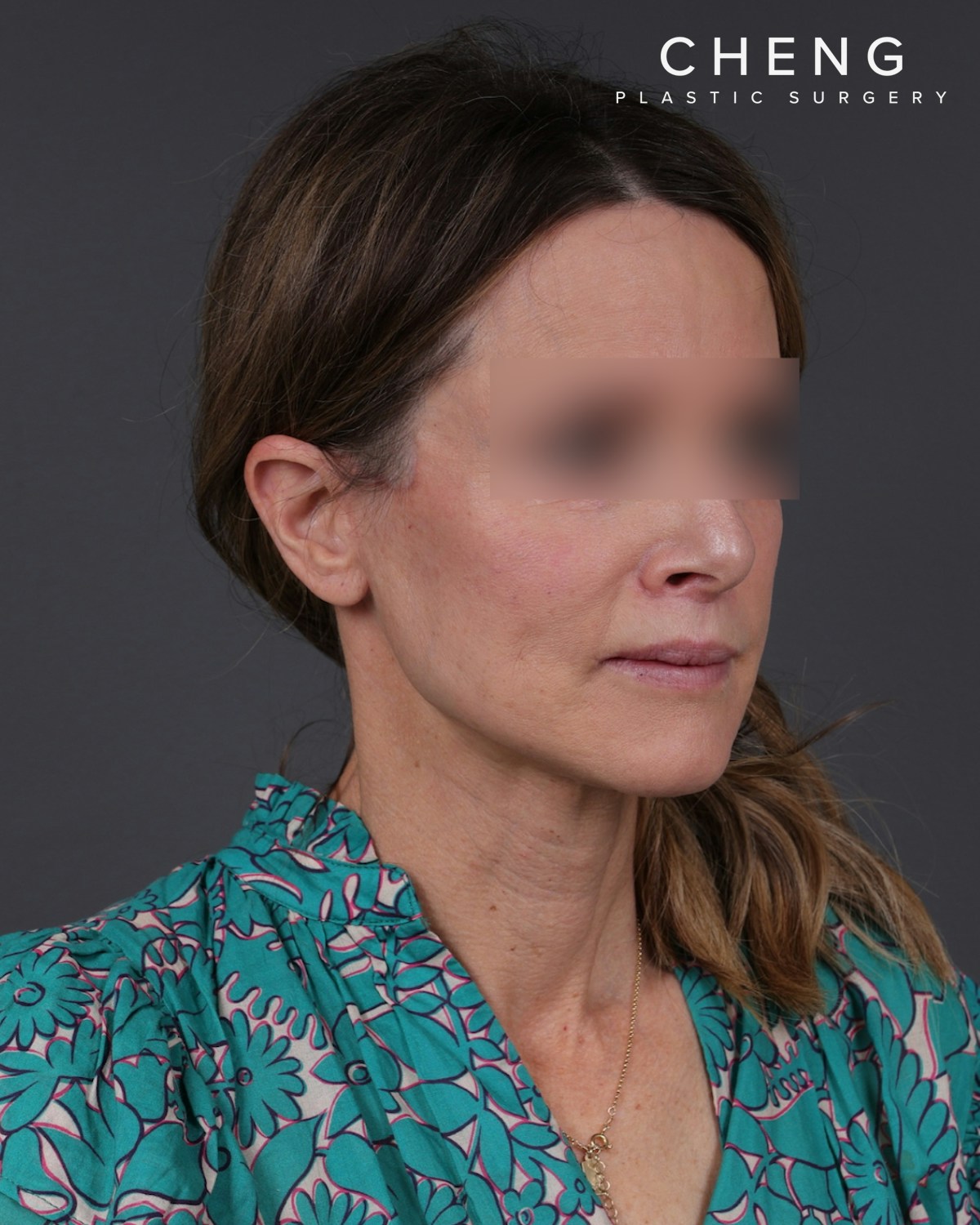 Facelift Before & After Gallery - Patient 263076 - Image 4