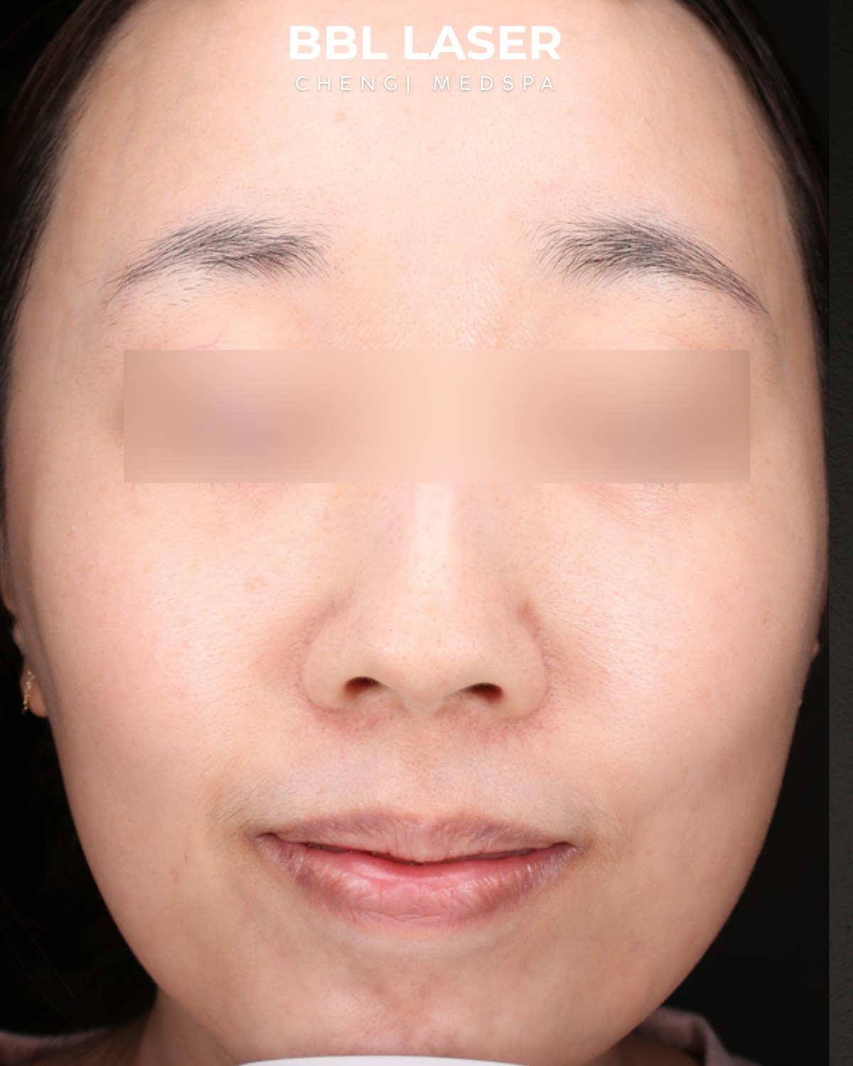 BBL Laser Before & After Gallery - Patient 157854 - Image 2