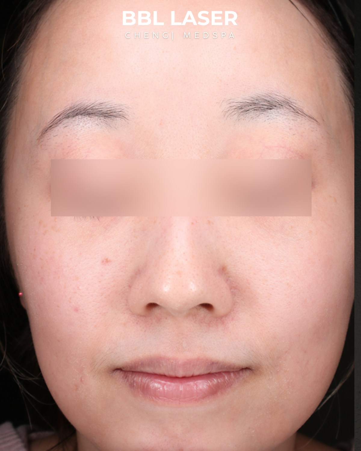 BBL Laser Before & After Gallery - Patient 157854 - Image 1