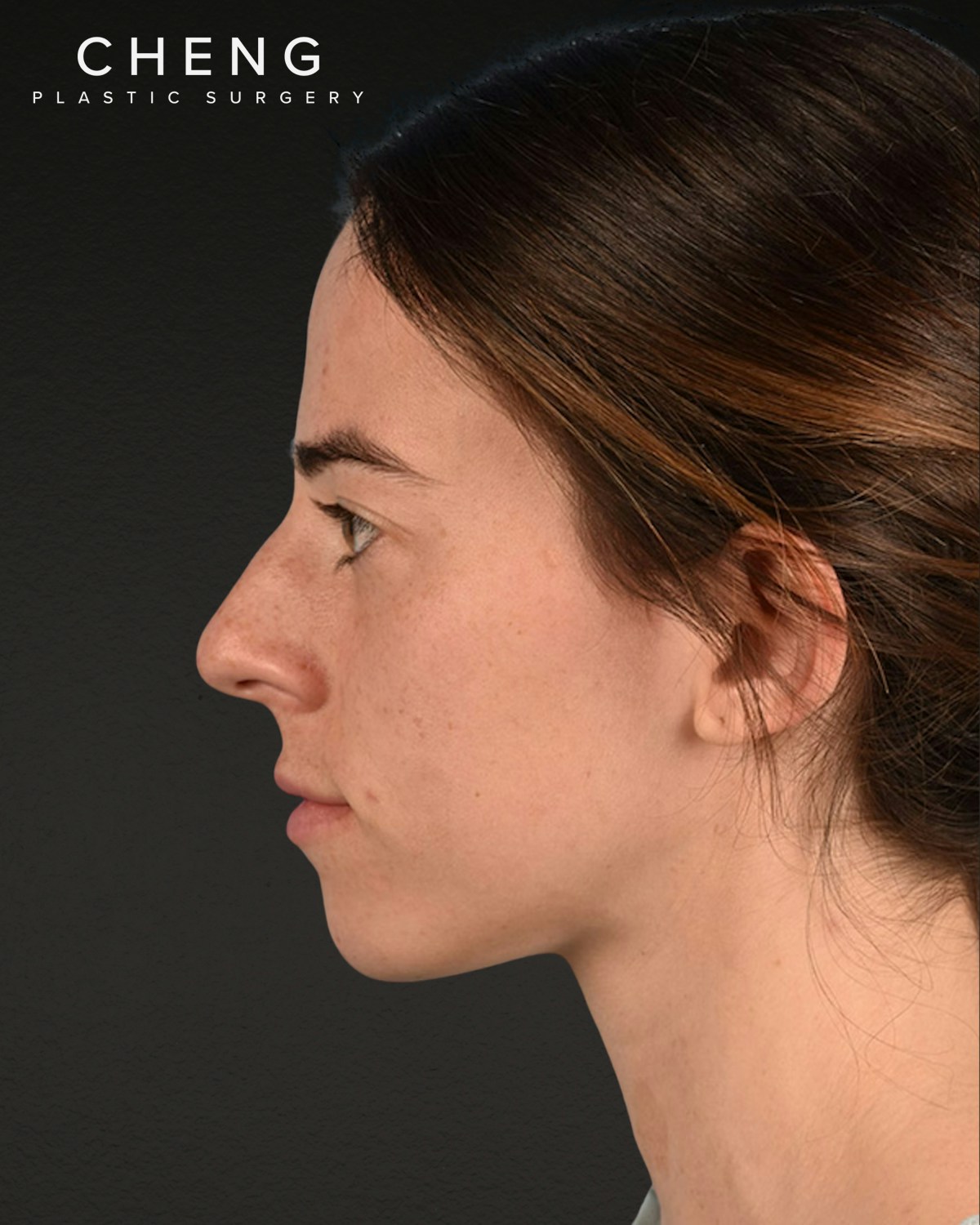 Rhinoplasty Before & After Gallery - Patient 172099 - Image 3