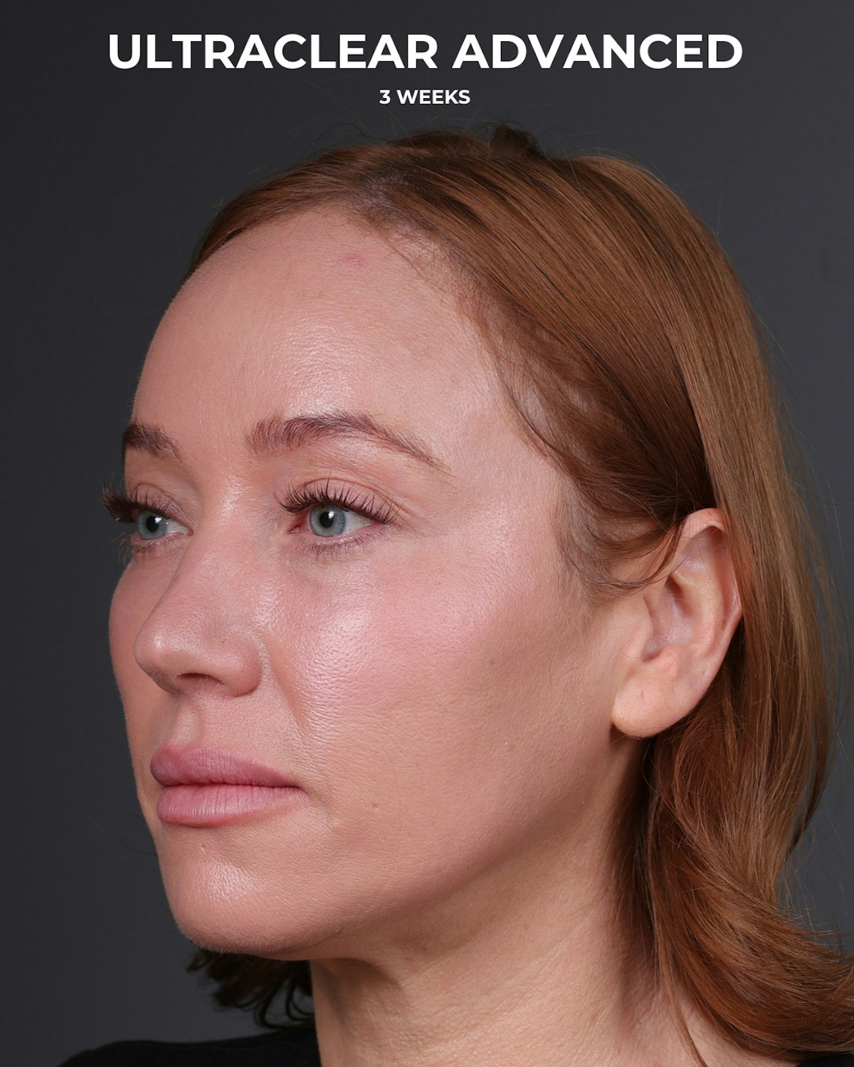 UltraClear Before & After Gallery - Patient 225417 - Image 6