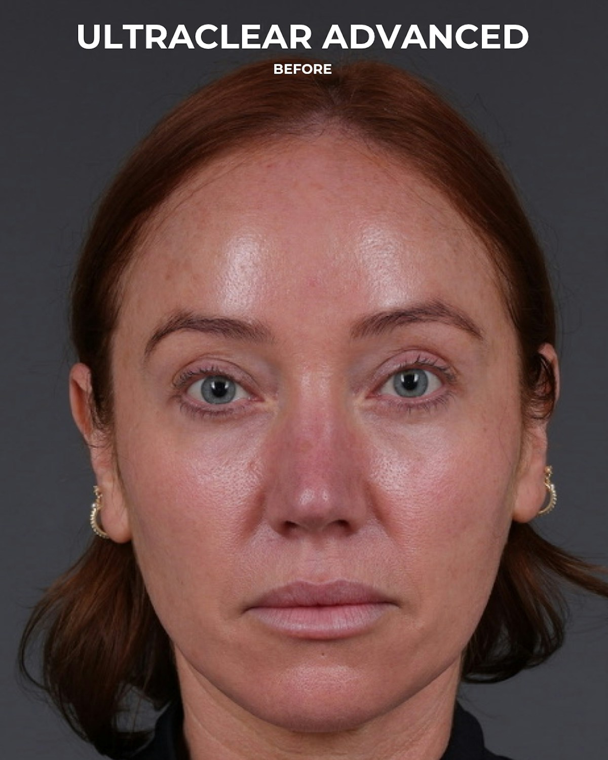 UltraClear Before & After Gallery - Patient 225417 - Image 1