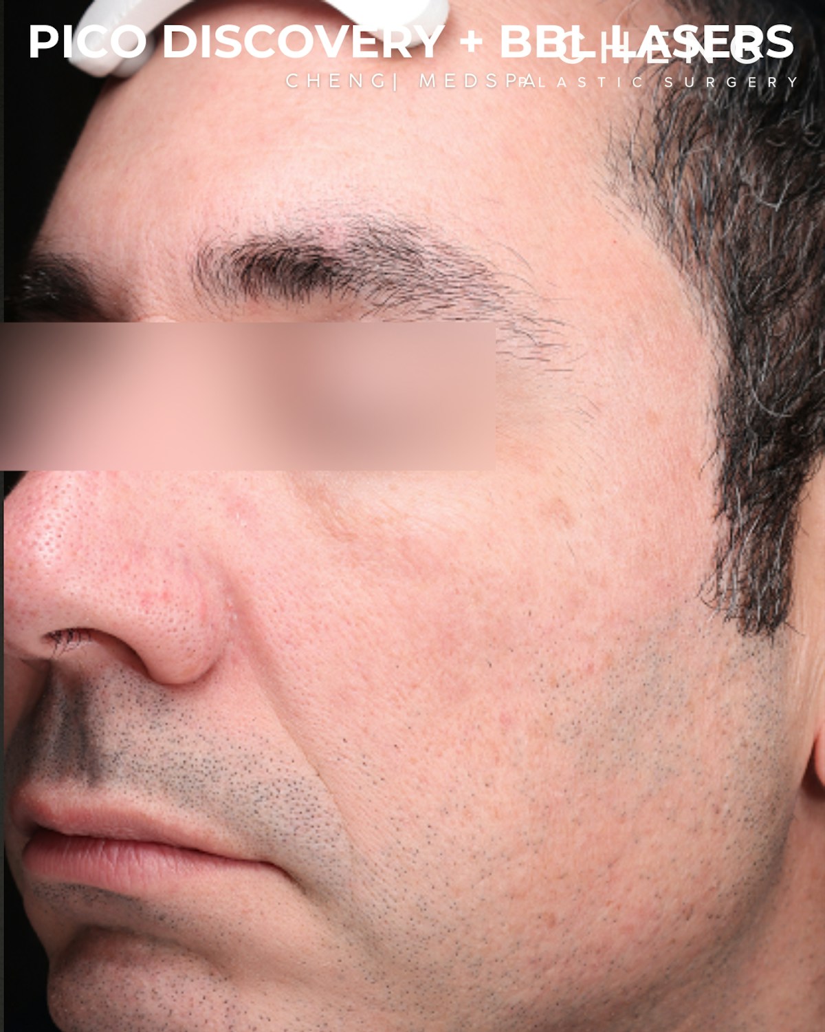 Pigment Laser Before & After Gallery - Patient 304692 - Image 4